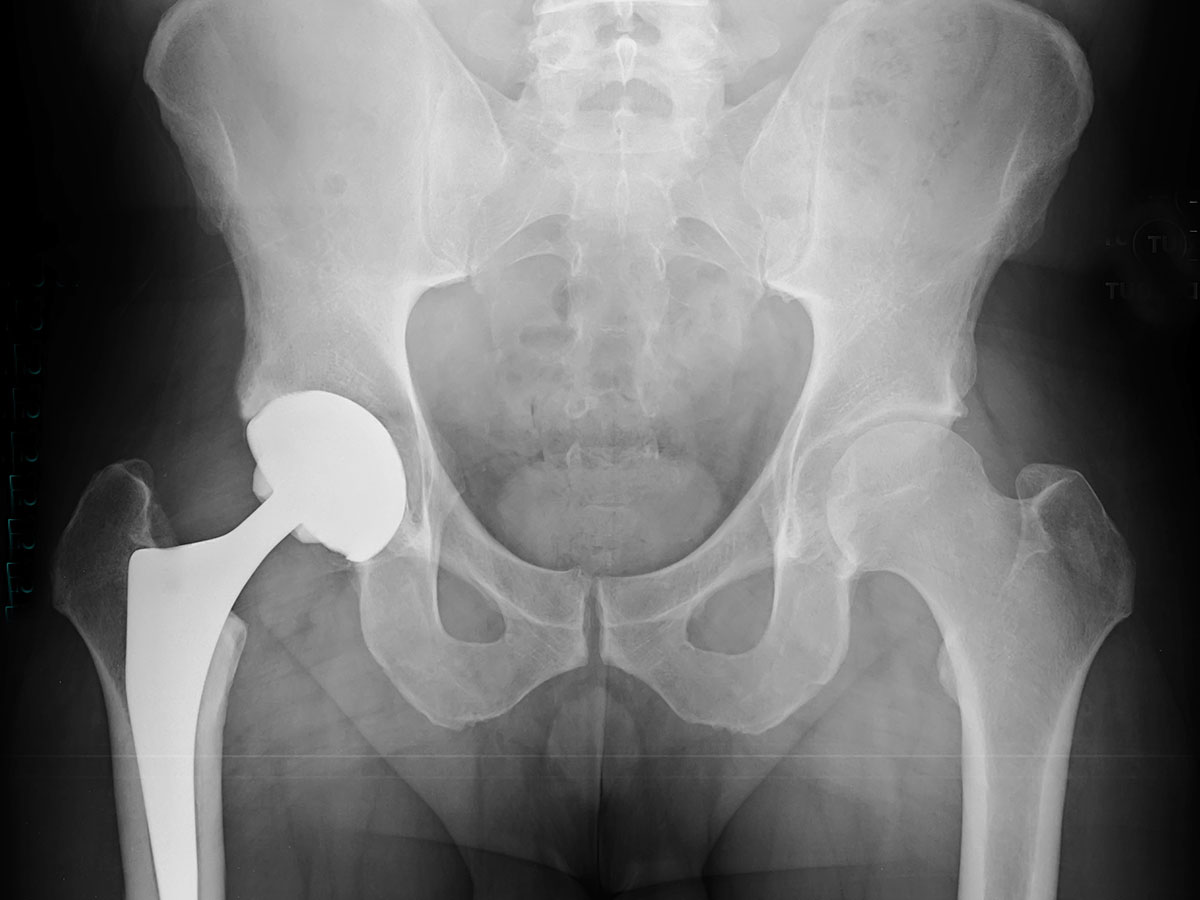 xray of normal hip joint